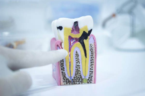 caries
